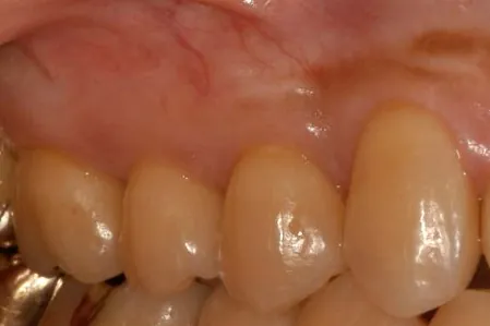歯周形成外科治療　歯肉退縮　アフター