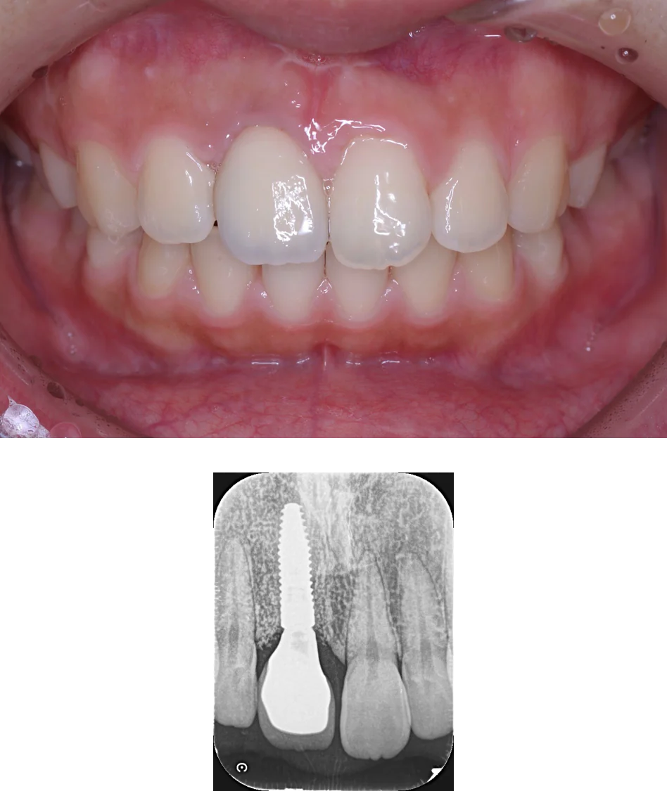 ②インプラント審美障害（after