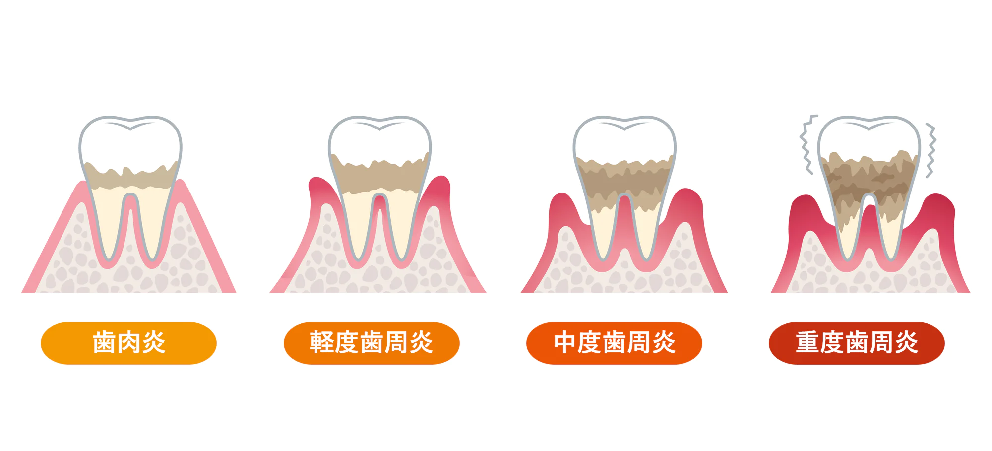 歯周病の進行度