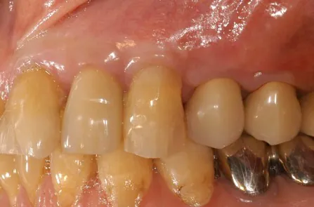 歯周形成外科治療　歯肉退縮　アフター