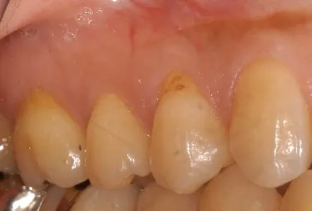 歯周形成外科治療　歯肉退縮　ビフォー