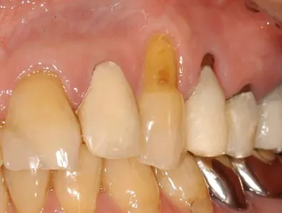 歯周形成外科治療　歯肉退縮　ビフォー