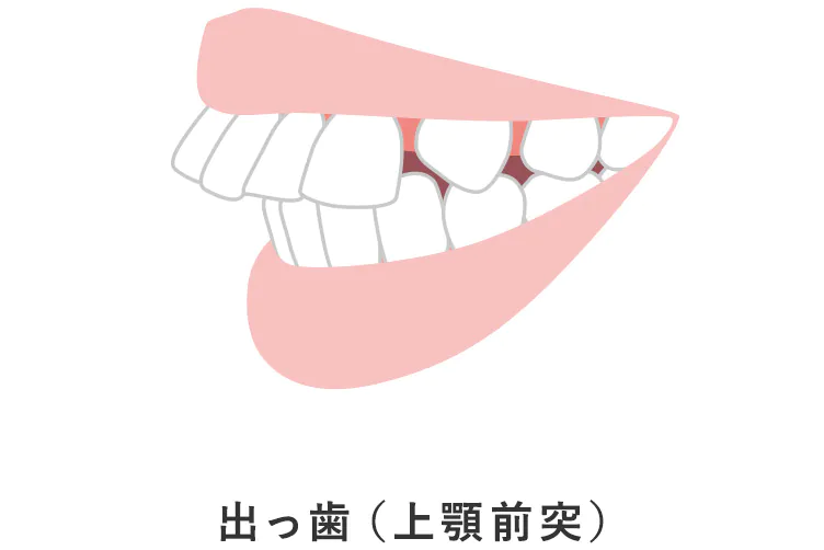 上顎前突(出っ歯)