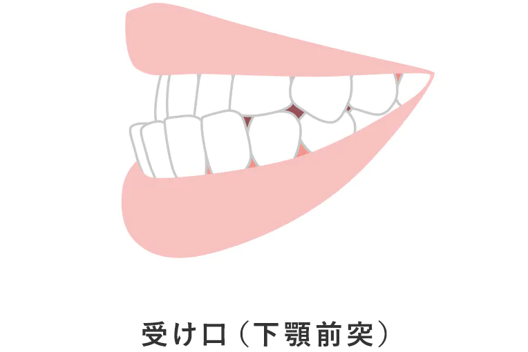 下顎前突(受け口)