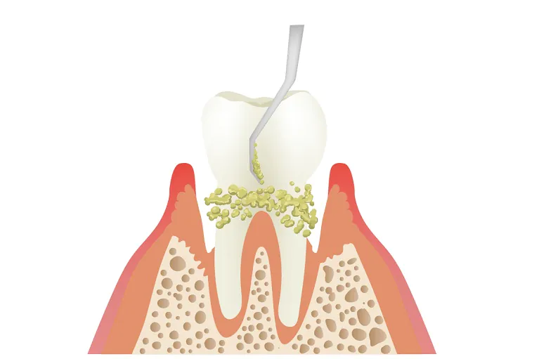 歯石除去（歯石取り）