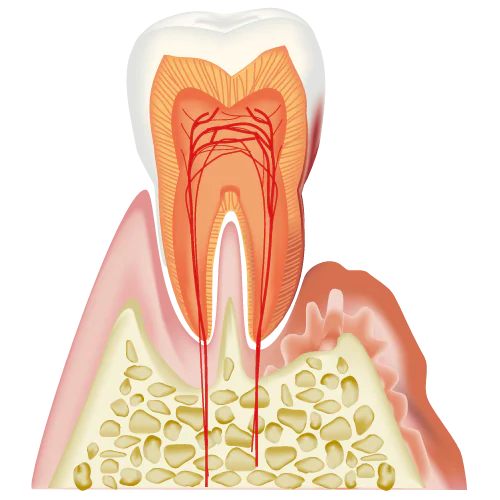 歯周病