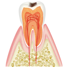 エナメル質に影響し始めた虫歯(C1)