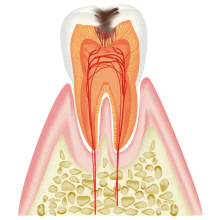 象牙質まで進行した虫歯（C2）