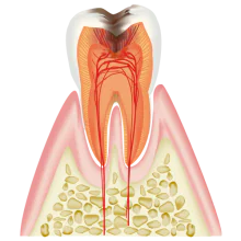 神経まで進行した虫歯（C3）