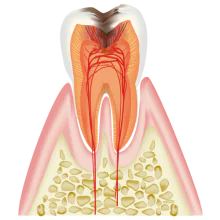重度の虫歯や歯髄炎