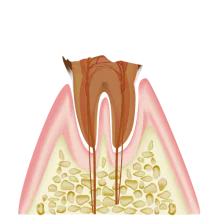 歯の根っこまで進行した虫歯（C4）