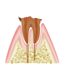 歯の根っこまで進行した虫歯(C4)